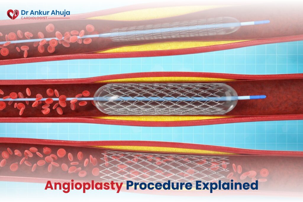 Angioplasty vs Bypass