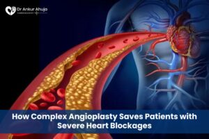 Complex Angioplasty