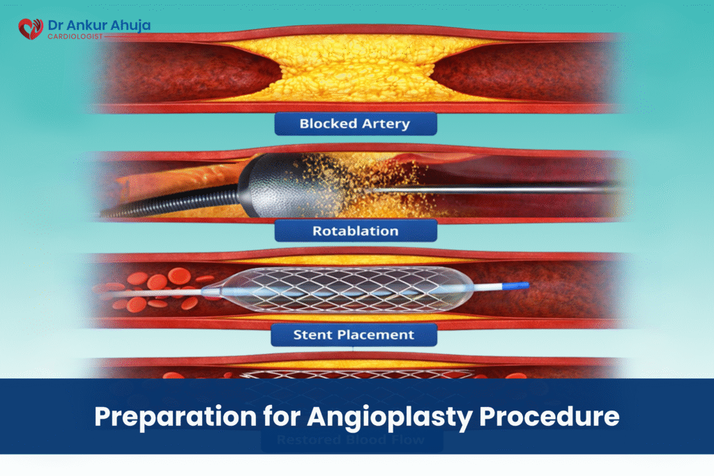 Angioplasty