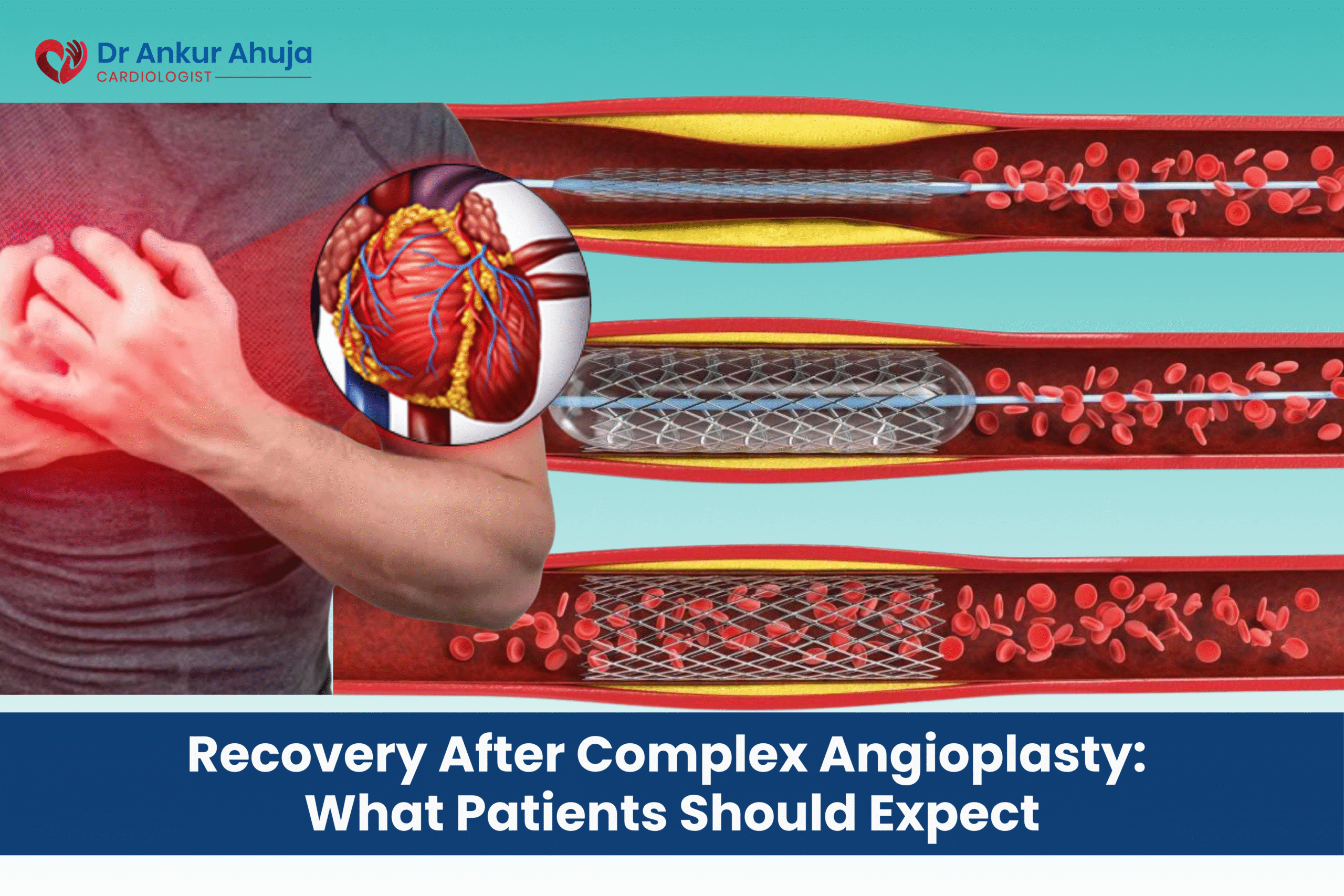 Complex Angioplasty